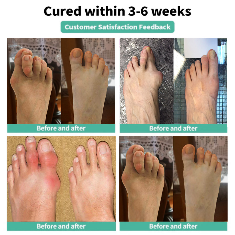 🏅Natravor® Botanical Bunion Comfort Patch 👠💃（Physical Stretch Support + Botanical Comfort Formula)