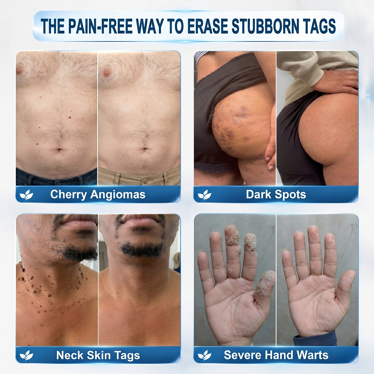 Natravor® 7-𝐃𝐚𝐲 𝐒𝐤𝐢𝐧 𝐓𝐚𝐠 & 𝐒𝐩𝐨𝐭 𝐄𝐫𝐚𝐬𝐞𝐫 𝐂𝐫𝐞𝐚𝐦 (Zero Pain, Zero 𝐒𝐜𝐚𝐫𝐬 Formula) 💎