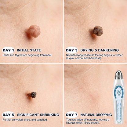 𝐎𝐟𝐟𝐢𝐜𝐢𝐚𝐥 𝐁𝐫𝐚𝐧𝐝 𝐒𝐭𝐨𝐫𝐞 |✅🎉Natravor® 7-Day Tag & Spot Eraser Rollerball | Gentle, Easy-to-Use Skin Care