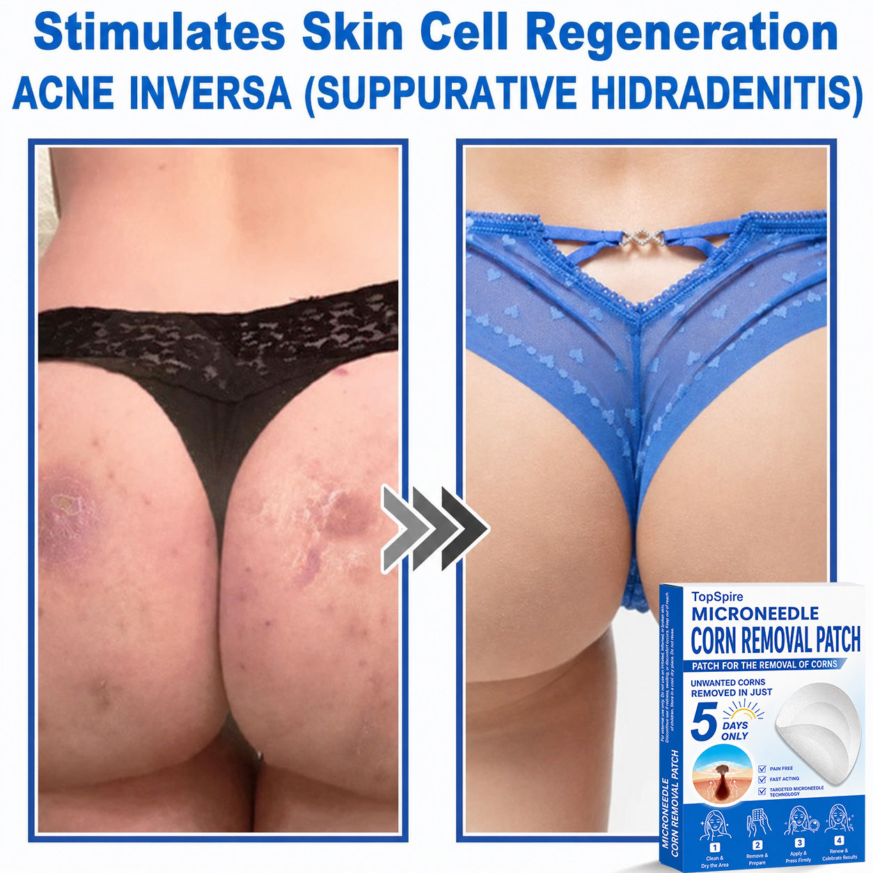 ✨TopSpire® 2-in-1 Microneedle & Hydrocolloid Patch | Targeted Solution for Raised Moles, Acne, Flat Warts & Skin Tags | Helps Improve the Appearance of Fine Lines, Scars & Skin Imperfections | Invisible Star Pimple Patches for Face & Body