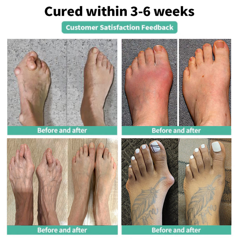 🏅Natravor® Botanical Bunion Comfort Patch 👠💃（Physical Stretch Support + Botanical Comfort Formula)